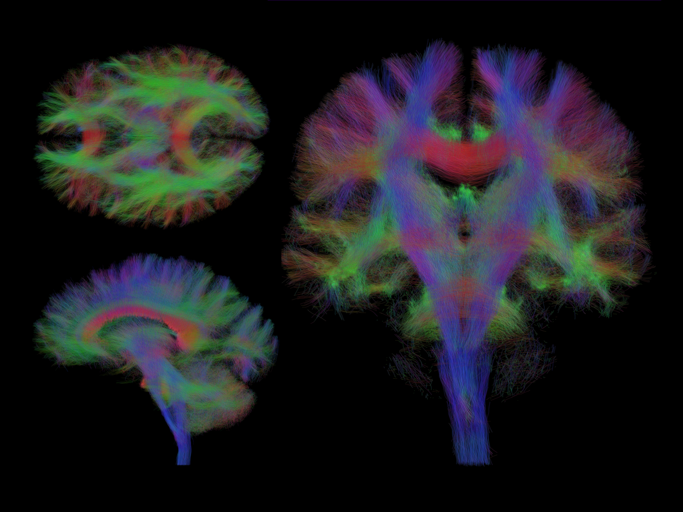 MAGNETOM Cima.X Tractography Three-Plane