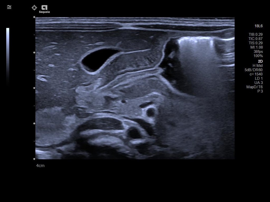 Neonatal imaging of the pylorus utilizing the 18L6 transducer 
