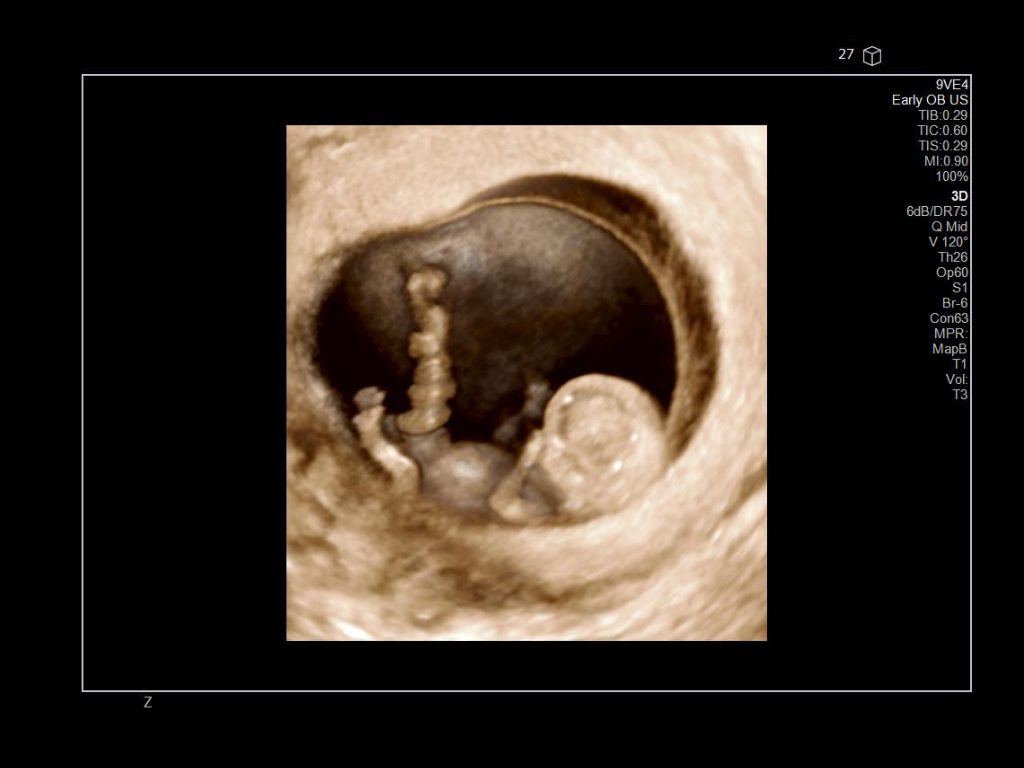 This image demonstrates a 9VE4 endovaginal 3D surface rendering image of an early OB.