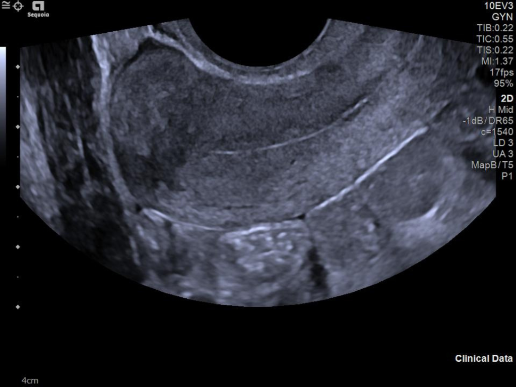 Sagittal uterus image on the ACUSON Sequoia
