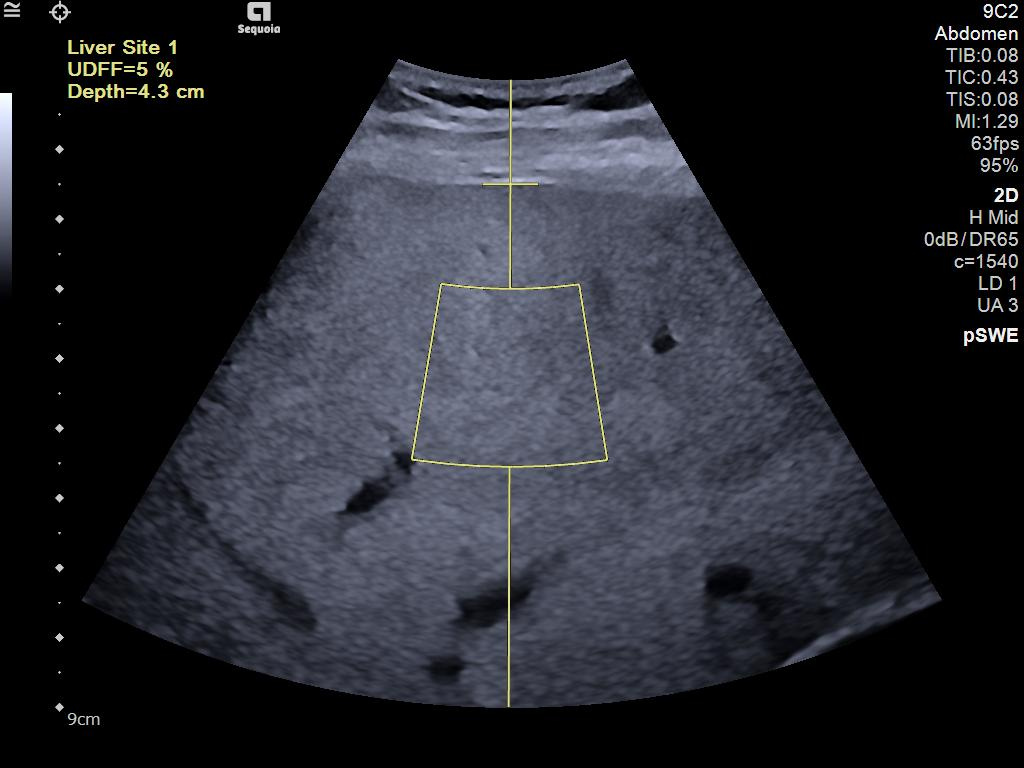 UDFF Liver Fat Quantification on the ACUSON Sequoia