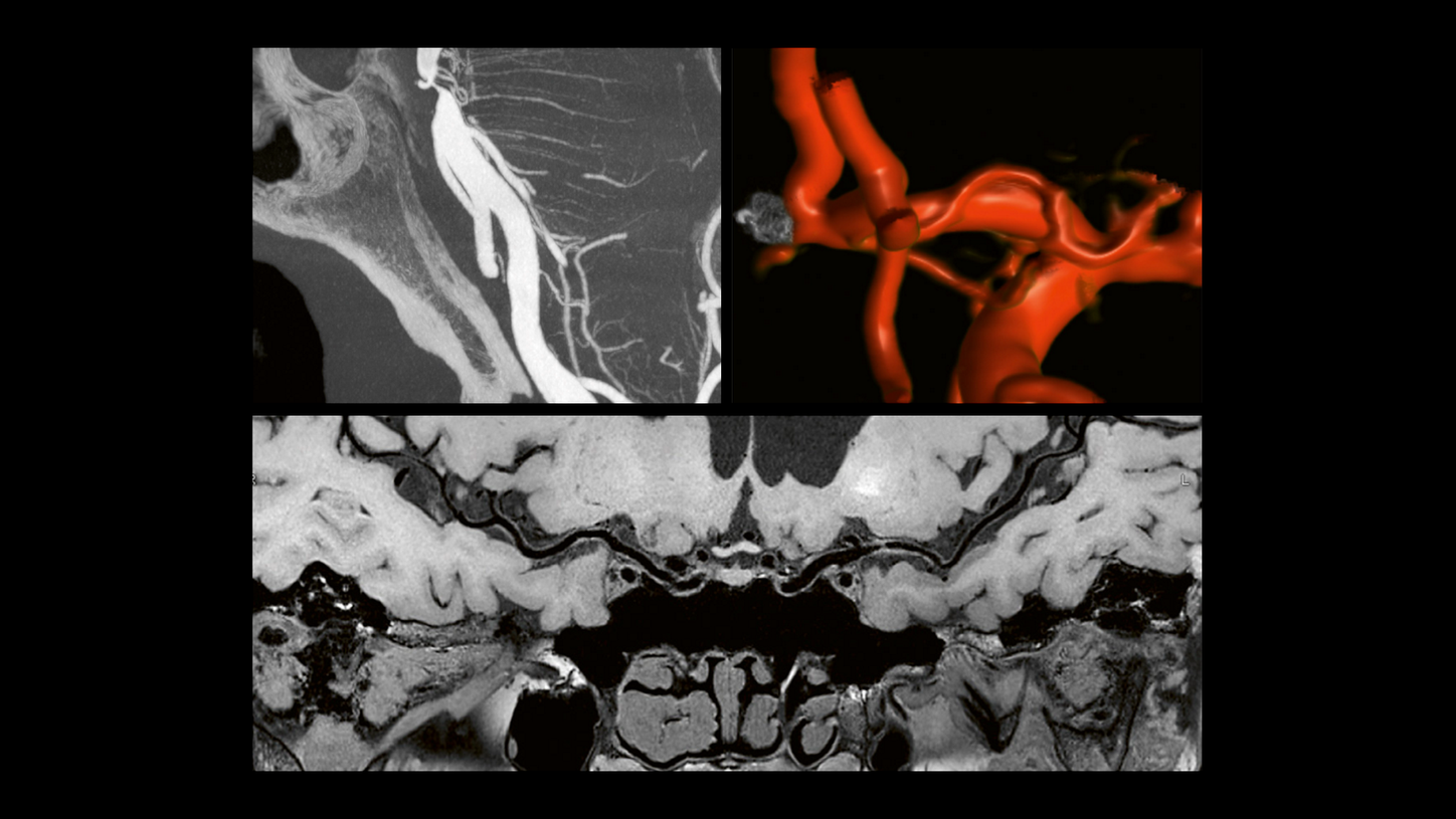 Collage of clinical images that show strokes