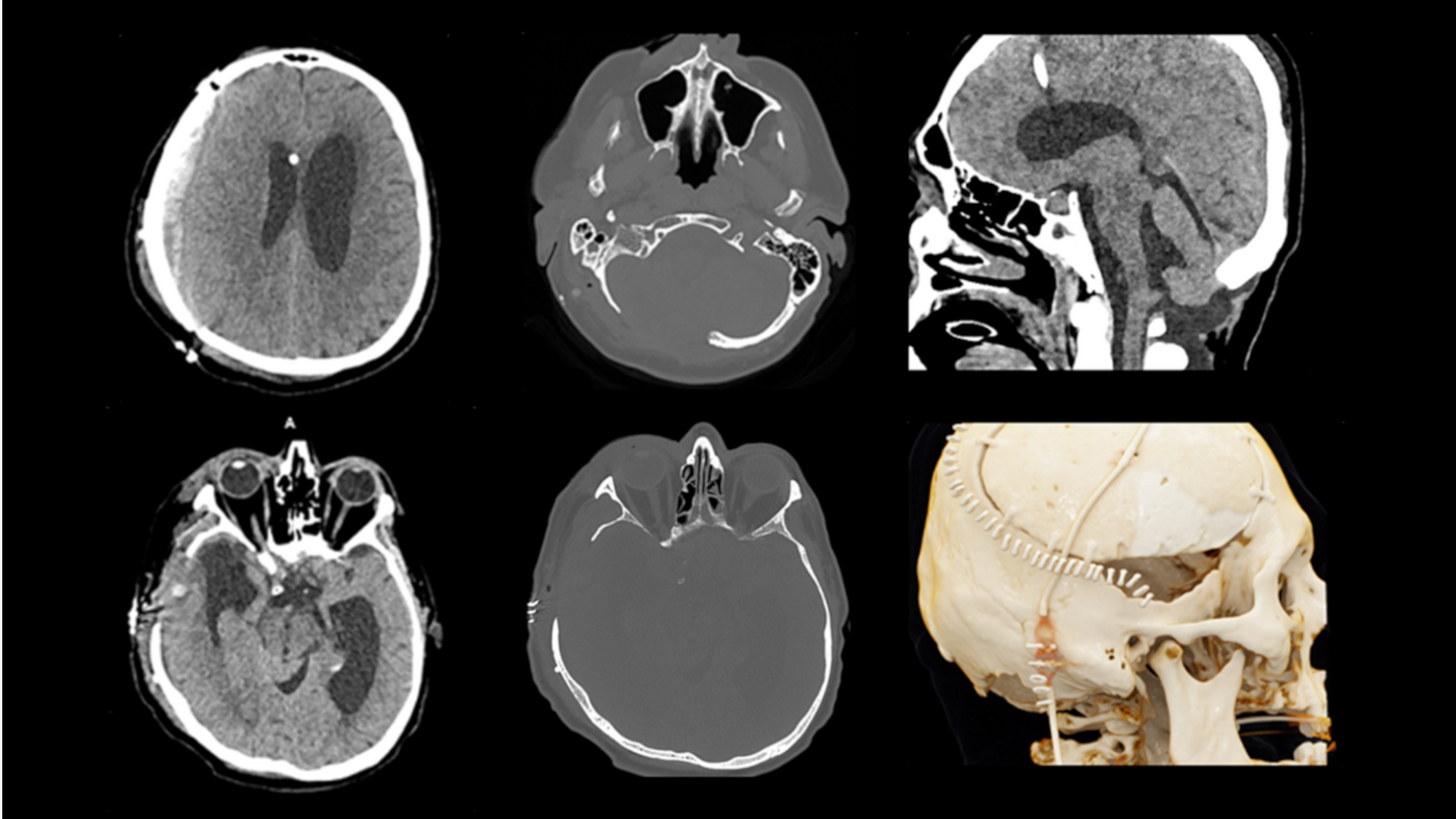 Scan results featuring a small acute intracranial hemorrhage taken by SOMATOM On.site at 120 kVp.