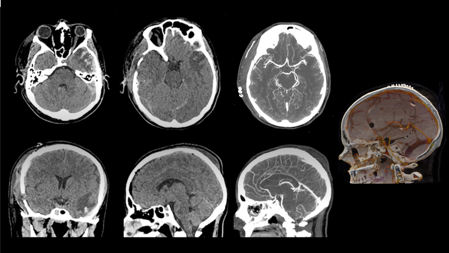 Scan results featuring ischemic stroke taken by SOMATOM On.site at 120 kVp.