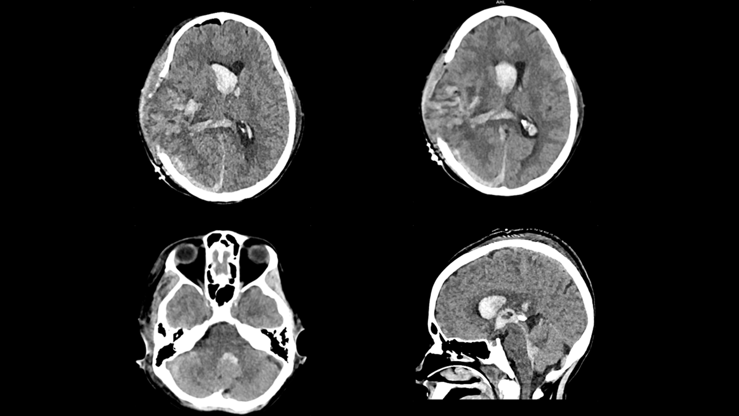 An overview of SOMATOM On.site imaging capabilities, featuring the brain window, contrast media enhanced image, bone window, and MIP imaging.