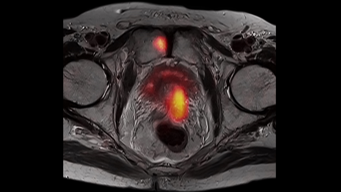 Prostate cancer – PET/MR imaging