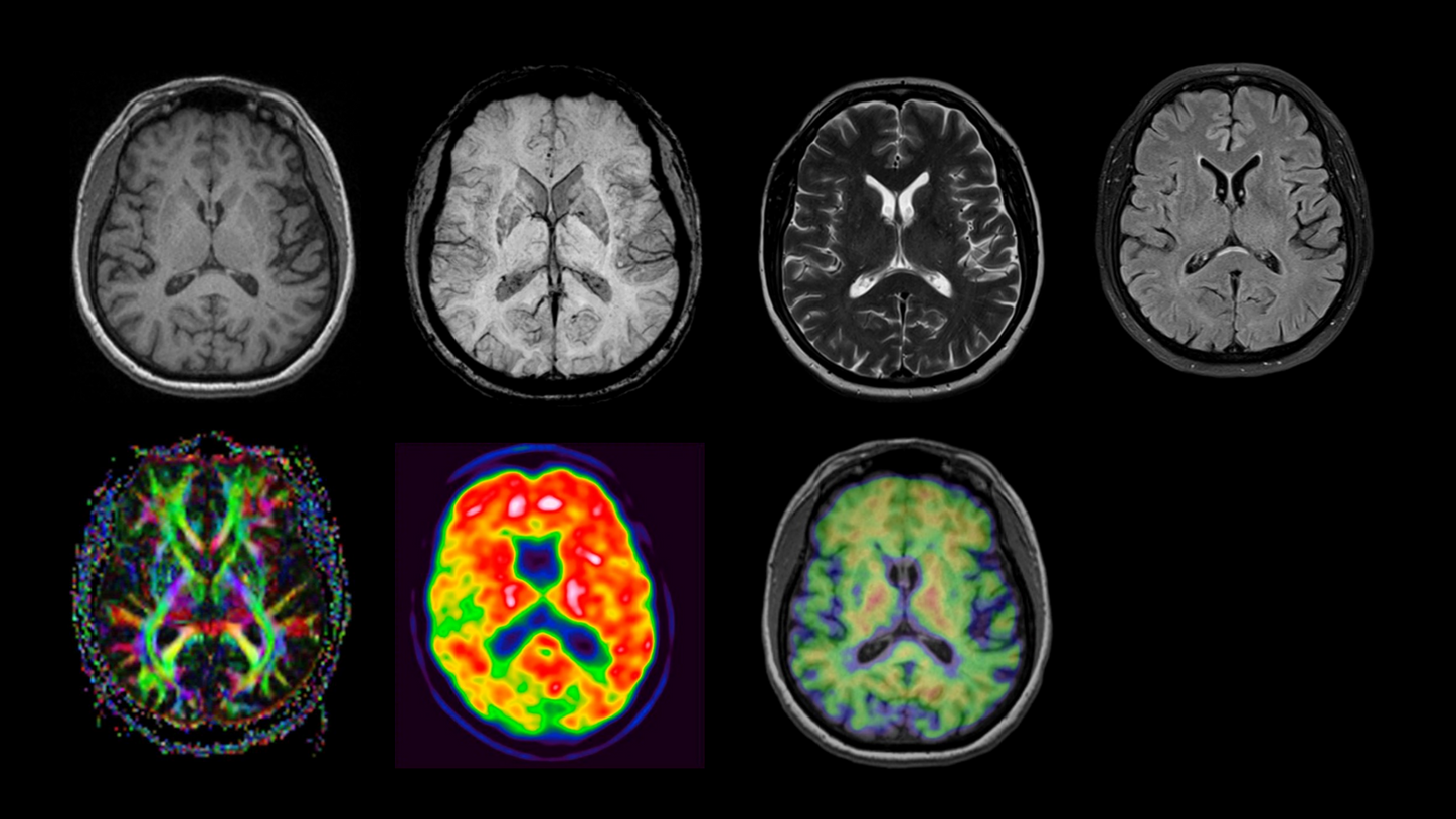 Multiparametric MRI and Amyloid imaging – PET/MR imaging