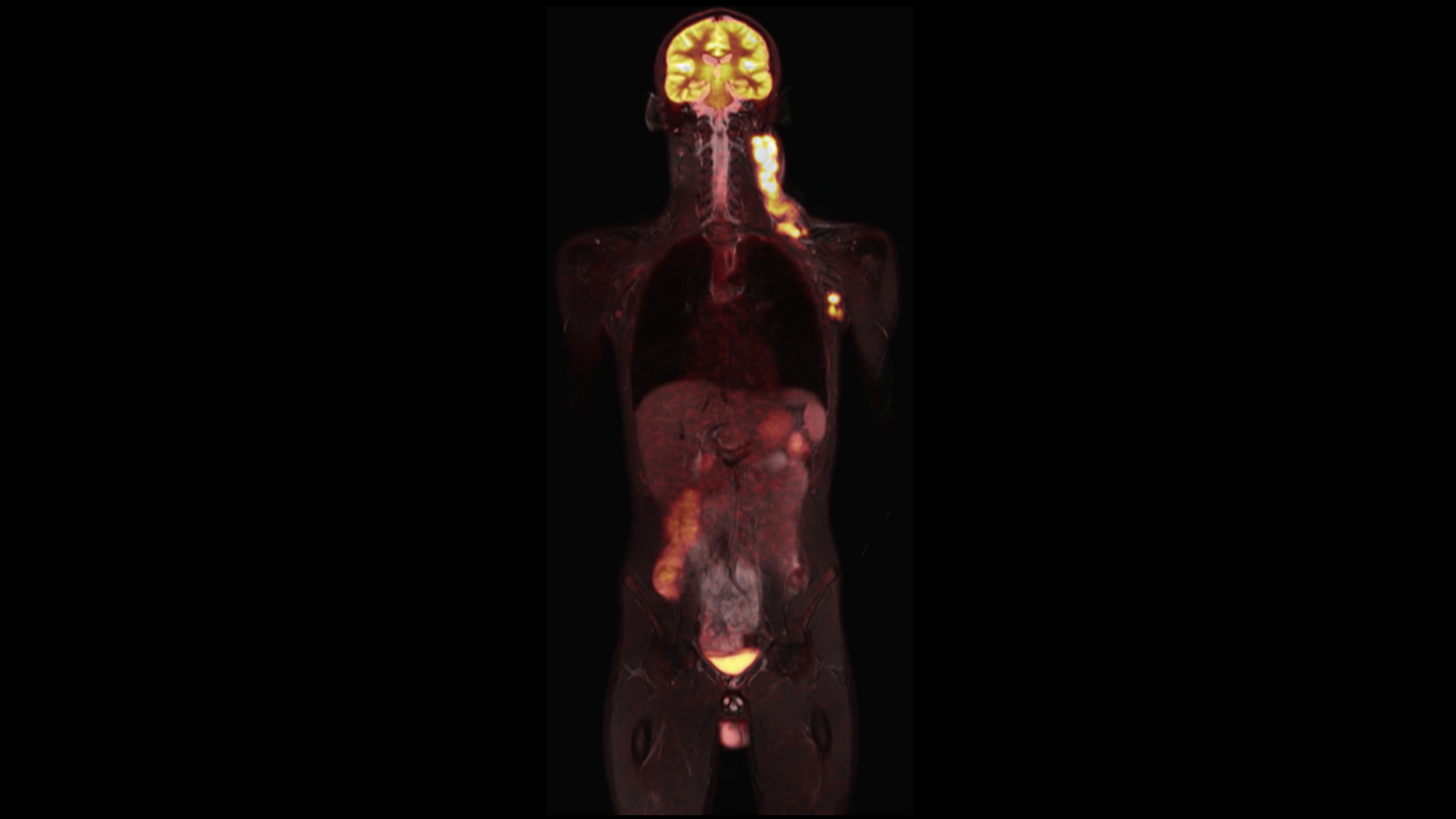 Lymphoma – PET/MR imaging