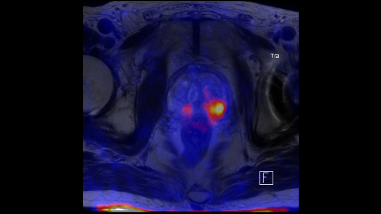 Prostate Cancer – PET/MR imaging