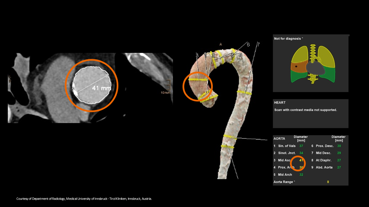 AI in radiology Reporting