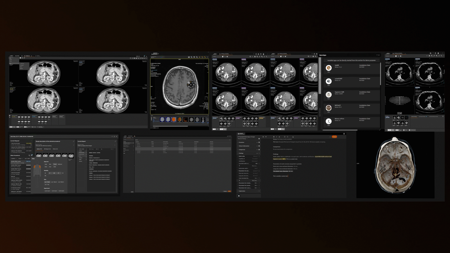 AI in radiology_Syngo Carbon