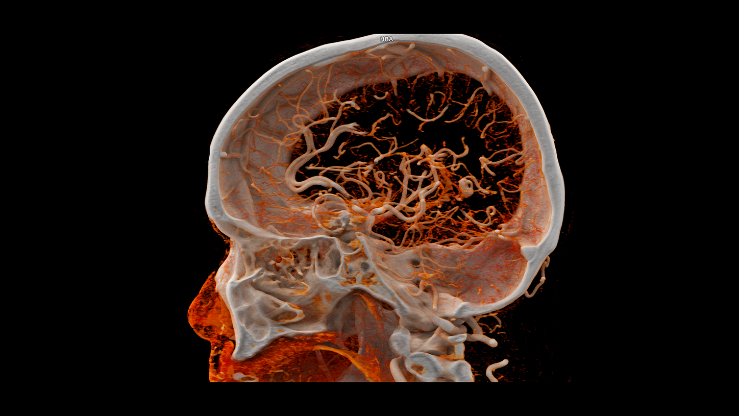 Saggital view of a Quantum HD head image with a surgical implant, acquired by a NAEOTOM Alpha photon-counting CT.