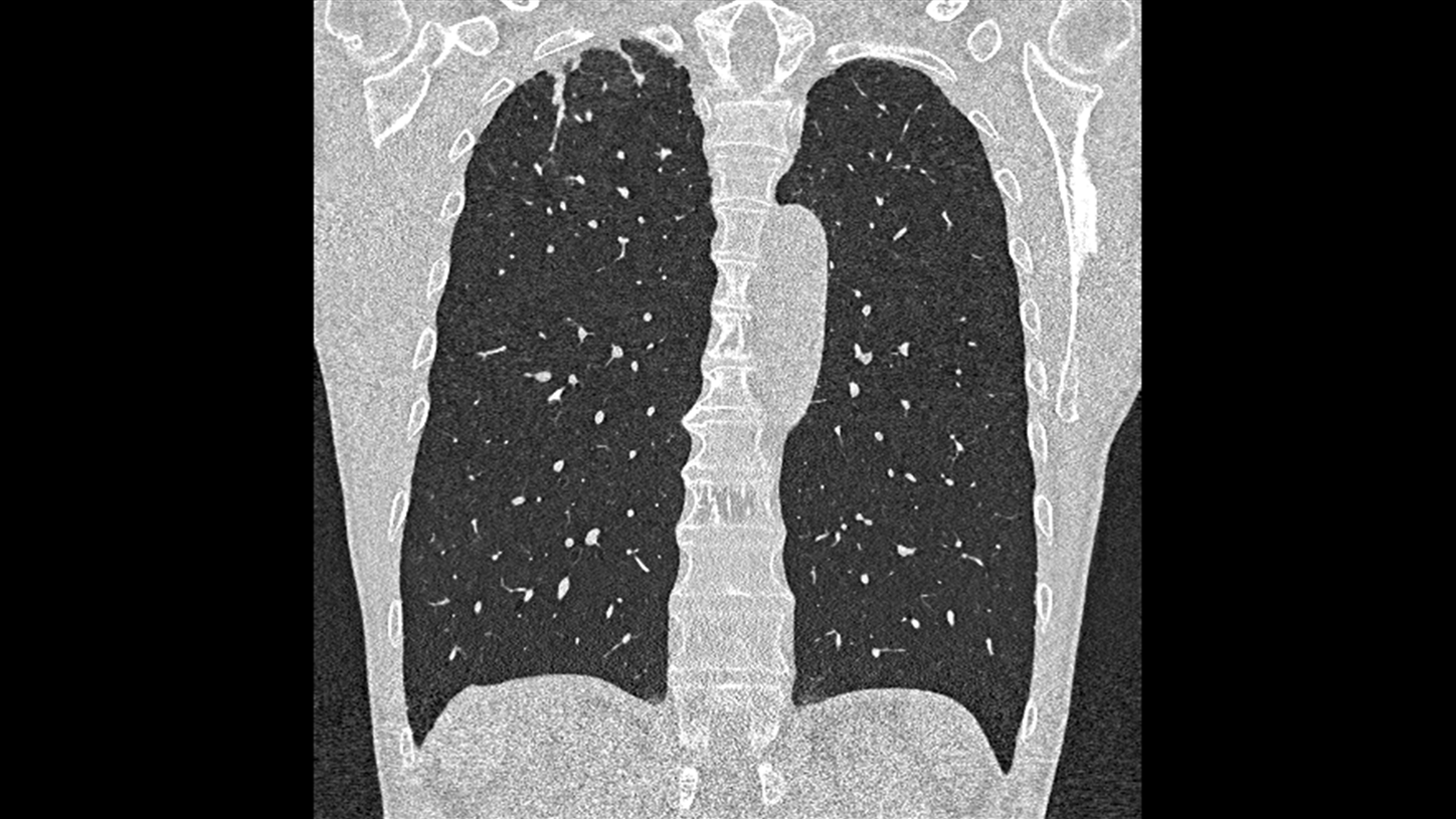 Clinical image of a spectral high-res lung CTA, acquired by a NAEOTOM Alpha photon-counting CT.