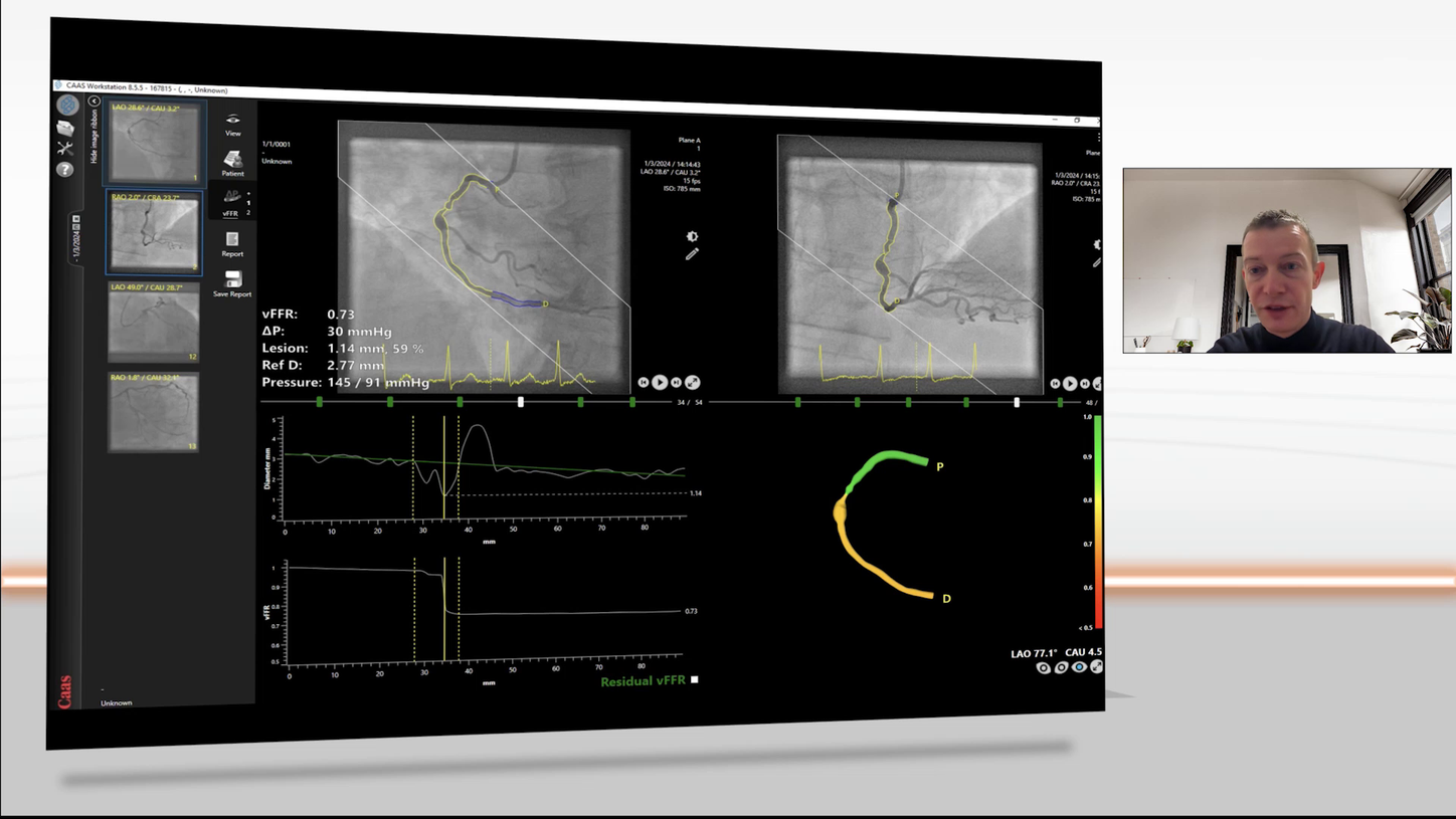siemens-healthineers_imaging_guided_pci_angio-based_ffr_daemen