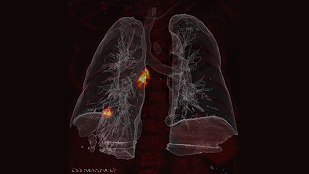 OncoFreeze AI - Deviceless motion management for PET imaging -   PET/CT lung scan