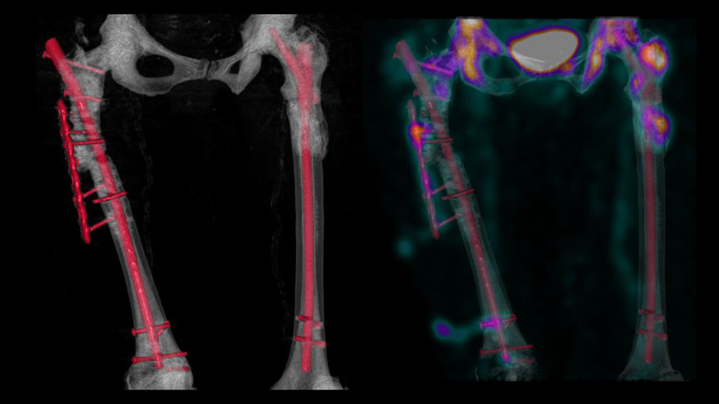 SPECT/CT in musculoskeletal medicine